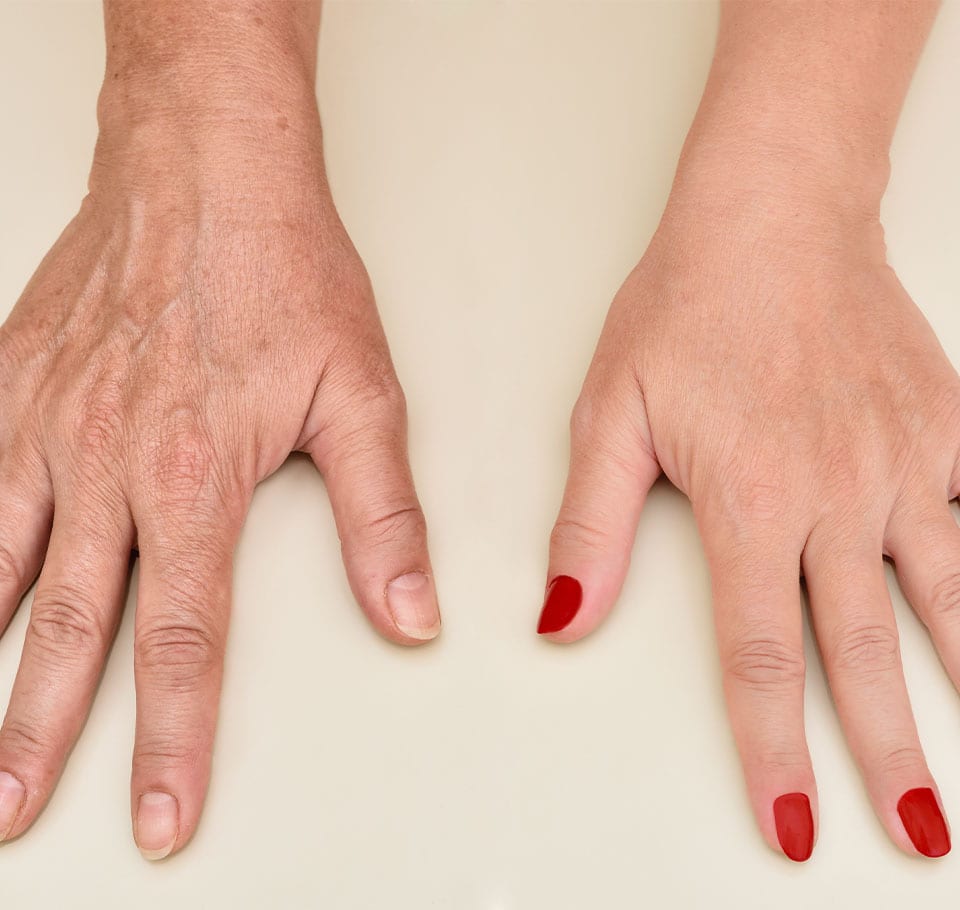 Wrinkle Hands Treatment London Ageing Hands Care Hotaki Clinic